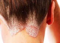 what does psoriasis look like on the scalp